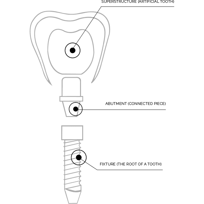 Dental implant diagram with labeled parts.