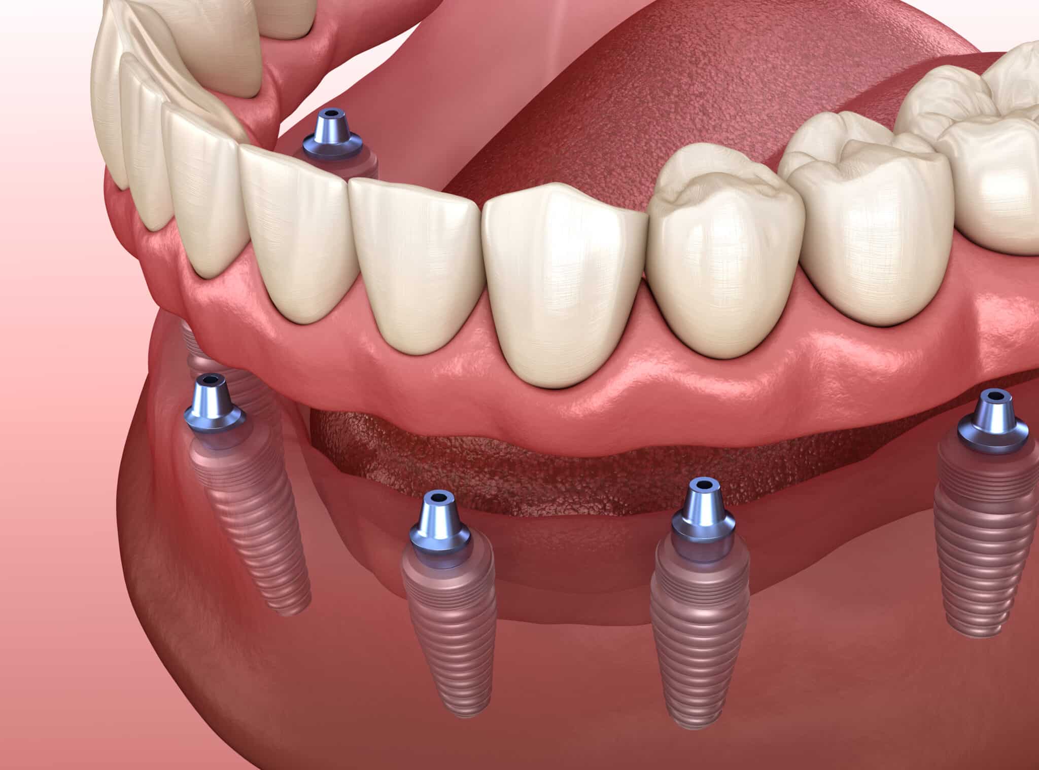 3D illustration of dental implants installation
