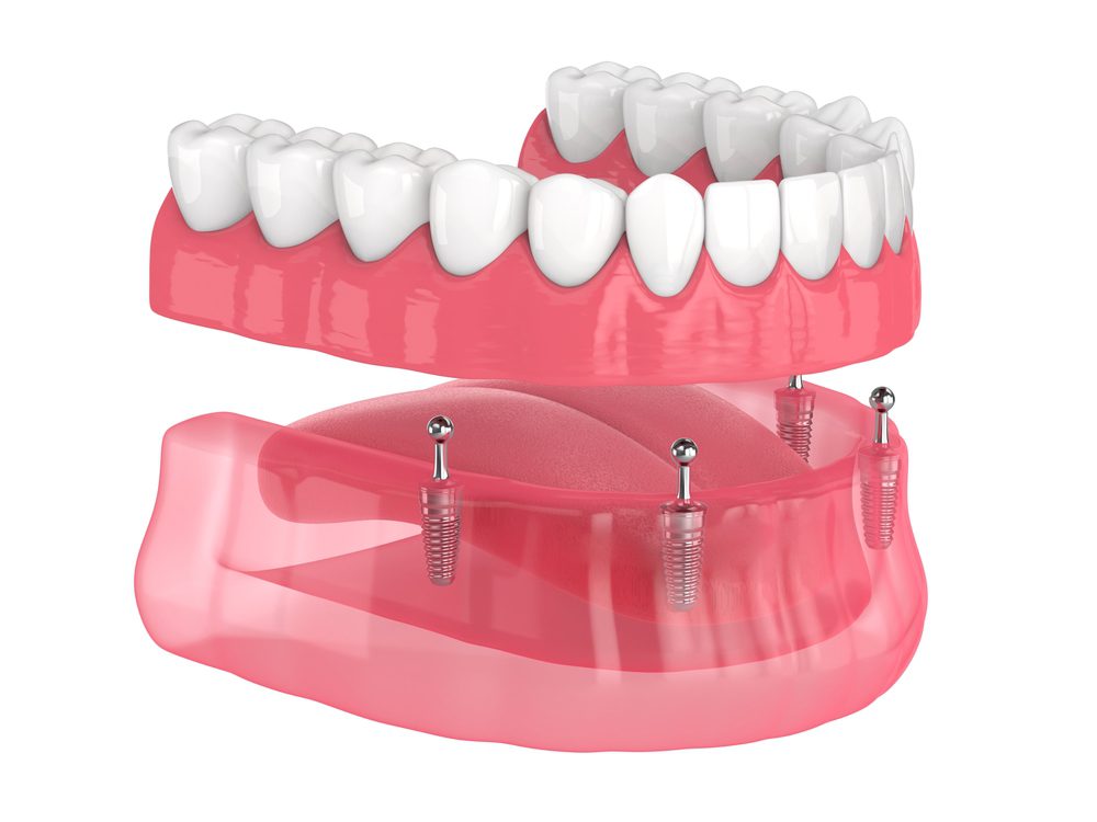 3D illustration of dental implant-supported dentures