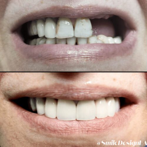 Before and after dental transformation