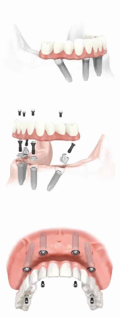 Dental implants supporting full arch prosthetic teeth.
